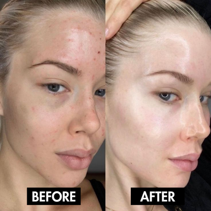 Lunoox™ Holy Basil Bubble Deep Mask