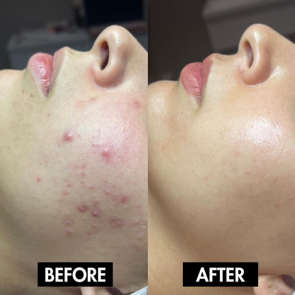 Lunoox™ Holy Basil Bubble Deep Mask