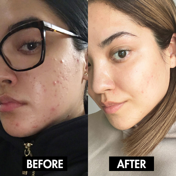 Lunoox™ Holy Basil Bubble Deep Mask