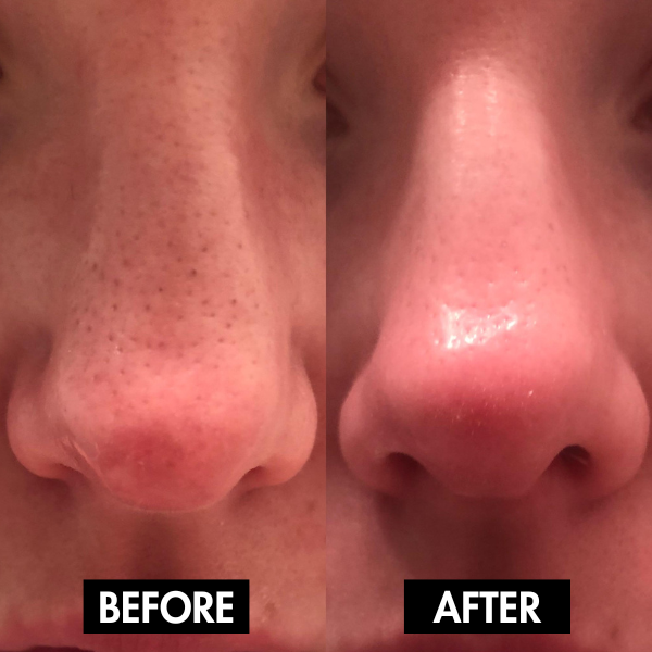 Lunoox™ Holy Basil Bubble Deep Mask